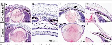 Figure From Anterior Segment Dysgenesis Correlation With Epithelial