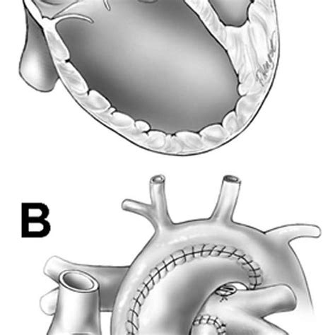 Stenosis Of The Proximal Right Ventricle To Pulmonary Artery Conduit