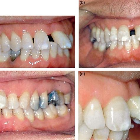 Ac Pretreatment Frontal And Lateral Intraoral Views D Overjet