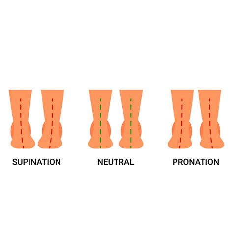 Supination Footprint