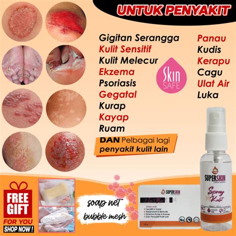 Ubat Kurap Gatal Kayap Kulit Sensitif Kudis Psoriasis Scabies Itchy