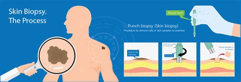 Skin Cancer Biopsy Skin Screen Skin Cancer Clinic Belmont Geelong