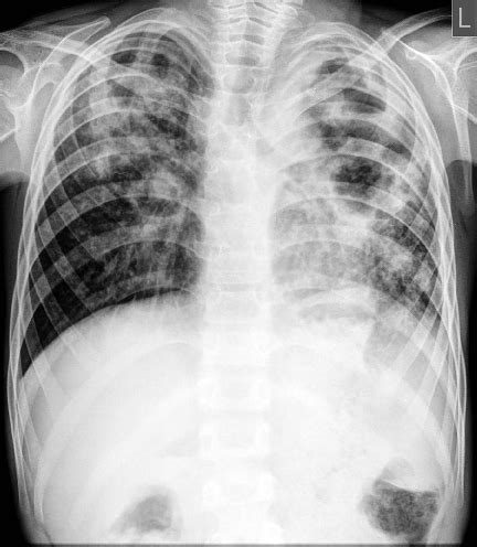 Chest X Ray Posteroanterior PA View Showing Opacities Suggestive Of