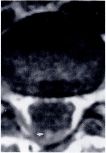 Case 20 7 Year Old Girl With Tethered Spinal Cord Syndrome Tip Of