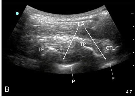 How We Do It Ultrasound Guided Thoracic Paravertebral Block Feedback