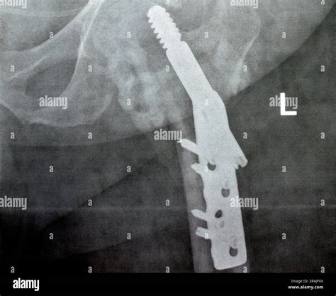 Left Hip Trans Cervical Neck Of Femur Fracture Fixated By Dhs Dynamic Hip Screw Plain X Ray Pxr