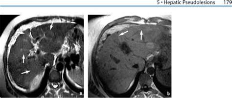 Images Anatomy For Mri Liver Contrast - MRI of the Liver