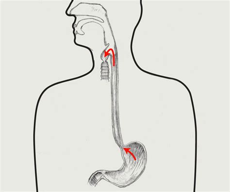 Laryngopharyngeal Lpr Reflux Treatment — True Voice Speech Pathology