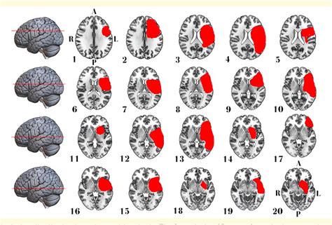 Figure 1 From Lesion Network Mapping Of Eye Opening Apraxia Semantic Scholar