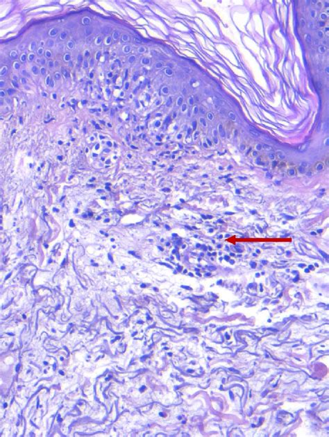 Histology Of A Skin Biopsy Performed On The Positive Intradermal Test Download Scientific