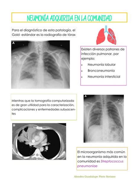 Radiología De La Neumonía Alondra Pinto Udocz