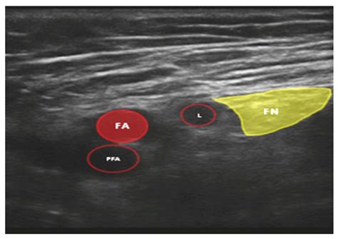 Ultrasound Guided Femoral Nerve Block Wfsa Resources