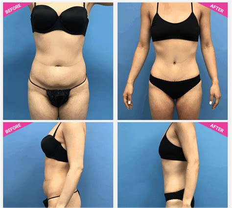 Liposuction Vs Tummy Tuck Which One Is Right For You