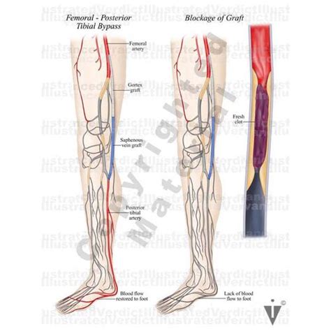 Stock Lower Limb Bypass Of Vasculature — Illustrated Verdict