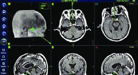 Intraoperative Image Guidance System Note Sphenoid Sinus Septa Which Download Scientific