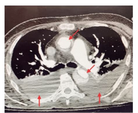 Contrast Enhanced Computed Tomography Scan Showing Cross Sectional Download Scientific Diagram