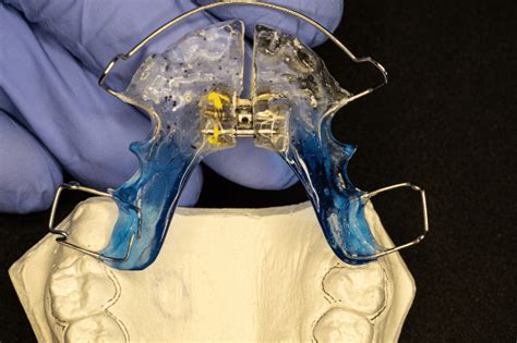 Qu Es Y Para Qu Sirve Un Disyuntor De Paladar Cl Nica Dental