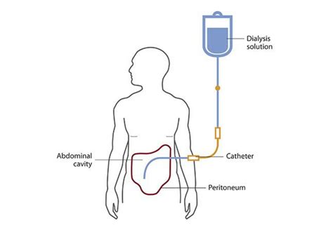 Solution Peritoneal Dialysis Studypool