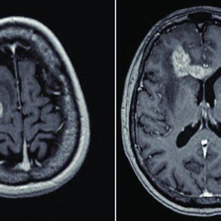 A Preoperative Axial Postcontrast T Weighted Image Of An Enhancing Gb