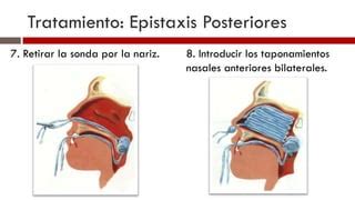 Epistaxis PPT