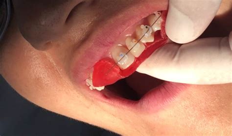 Como colocar um dente provisório no aparelho Provisórios na