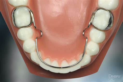 Shows A Lingual Arch On A Model Of Teeth Teeth Braces Cost Teeth