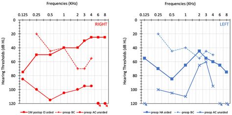 Audiometric Results Unaided Preoperative Air Conduction Ac And Bone Download Scientific