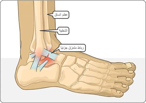 علاج التواء الكاحل بالصور