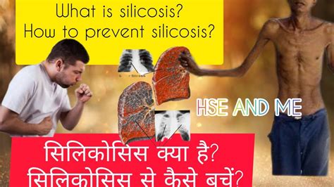 What is silicosis How to prevent silicosis सलकसस कय ह सलकसस