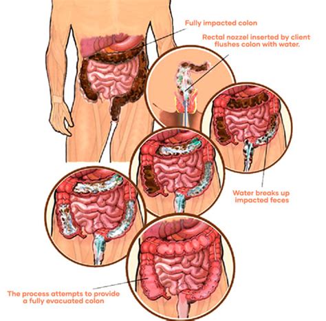 Colon Hydrotherapy Procedure