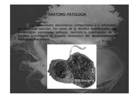 Hemorragia De La Segunda Mitad Del Embarazo PPT