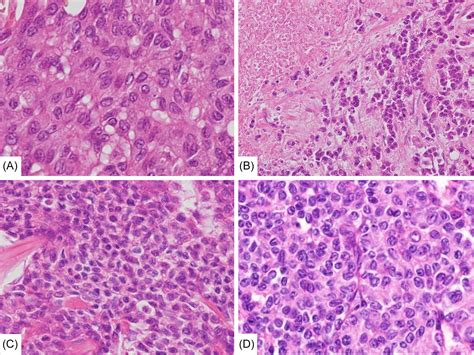 High‐grade Medullary Thyroid Carcinoma With Papillary‐like Nuclear