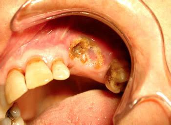 Osteonecrosis De Los Maxilares Por El Uso De Bifosfonatos Red