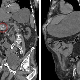 Initial Computed Tomography Of The Abdomen Revealed A A Large