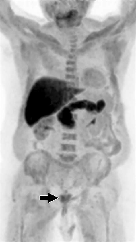 Fluorine Labeled Fluciclovine Pet Ct In Clinical Practice Factors