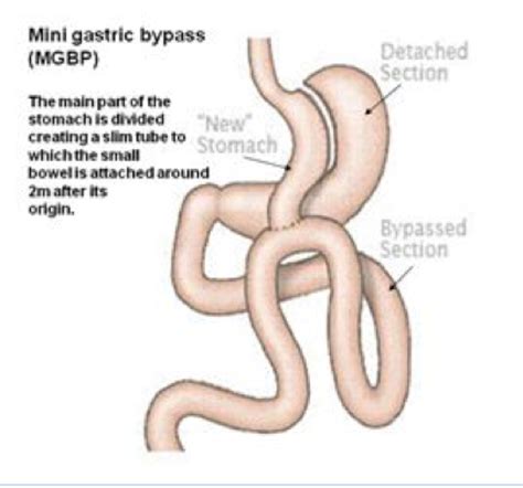 Mini Gastric Bypass Surgery Brisbane Omega Loop Gastric Bypass