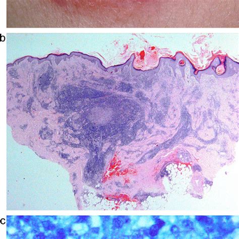 A Case Of Eumycetoma Showing A A Large Plaque With Atrophic Surface