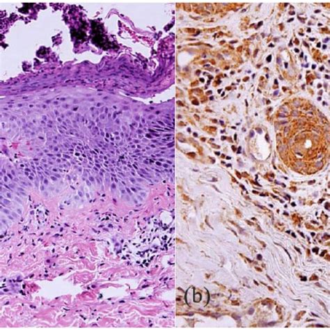 Histological Examination Of Annular Generalized Pustular Psoriasis A