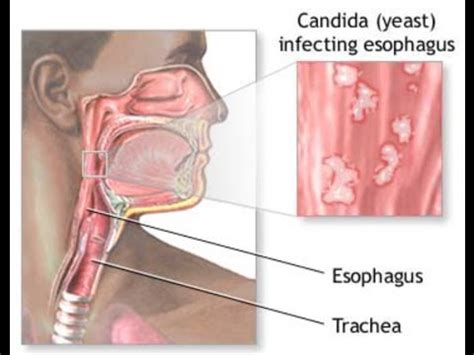 Candida Esophagitis - YouTube