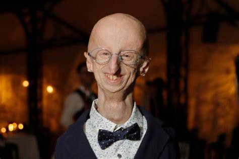 Sammy Basso Corpo Donato Alla Scienza Per La Cura Della Progeria