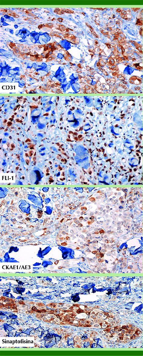 Vista Microscópico En Los Cortes Histológi Cos De Piel El Tumor Fue Download Scientific