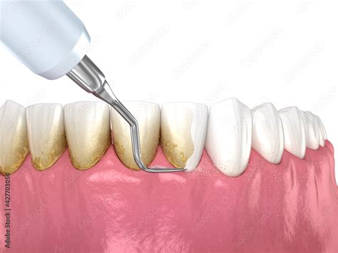 Oral Hygiene Scaling And Root Planing Conventional Periodontal