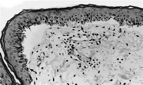 Lm Of A Mg Ml Of Hd Treated Ippsf Depicting Epidermal Dermal