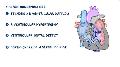 Tetralogy Of Fallot Video Anatomy And Definition Osmosis