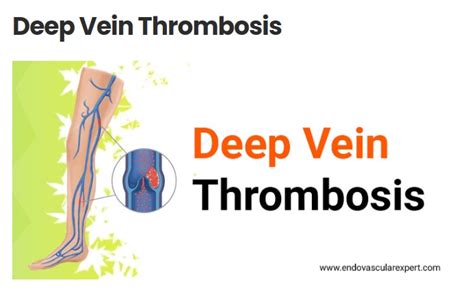 Chronic Venous Insufficiency Effects Of Dvt On Vein Health Theamberpost