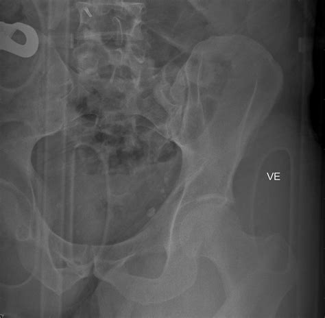 Subtrochanteric Fractures Trauma Orthobullets