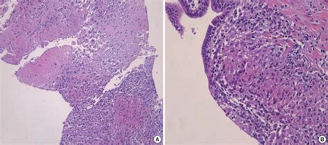 Granulomatous Inflammation In The Prostate Showing Central Necrosis