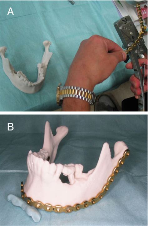 Mandibular Reconstruction Using Plates Prebent To Fit Rapid Prototyping