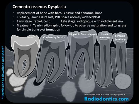 Focal Cemento Osseous Dysplasia