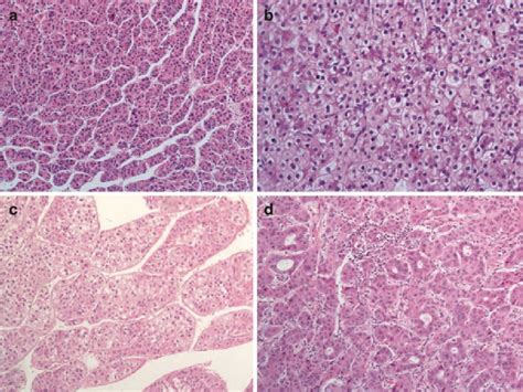 Main Histological Pattern Of Hepatocellular Carcinoma A